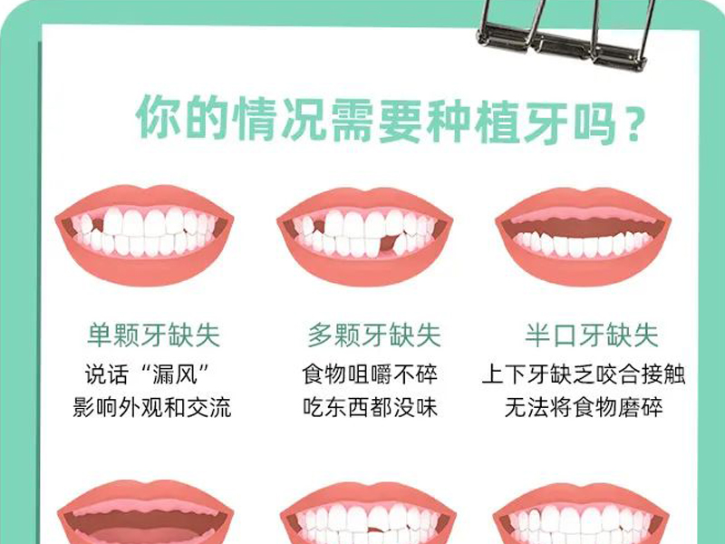 關于種植牙的一些套路